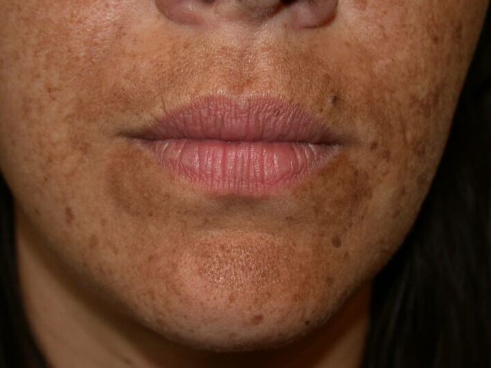 Pigmentvlekken op het gezicht zijn een indicatie voor een laserbehandeling