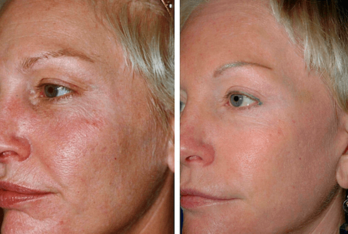voor en na fractionele huidverjonging foto 1
