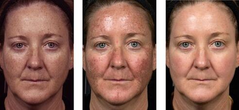 voor en na fractionele huidverjonging foto 2