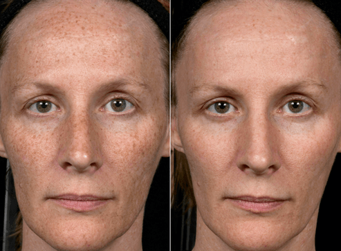 voor en na fractionele huidverjonging foto 3