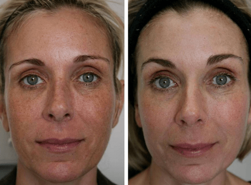 voor en na fractionele huidverjonging foto 4