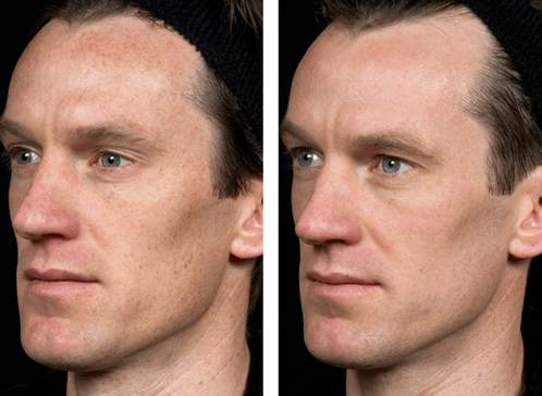 voor en na fractionele huidverjonging foto 5