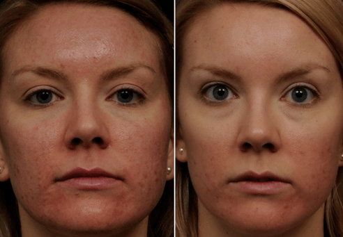 voor en na fractionele huidverjonging foto 6