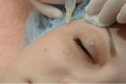 Mesotherapie