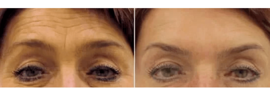 apparaten voor fractionele verjonging