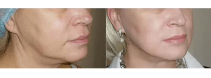 herstel na huidverjonging