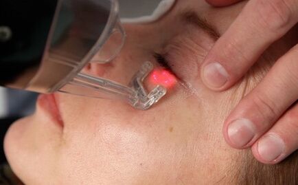 laser gezichtshuidverjongingsprocedure